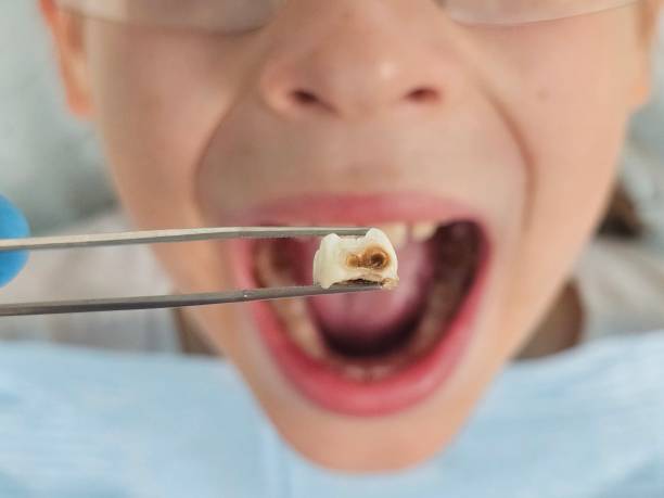 Best Emergency Treatment for Oral Infections in Edisto, SC