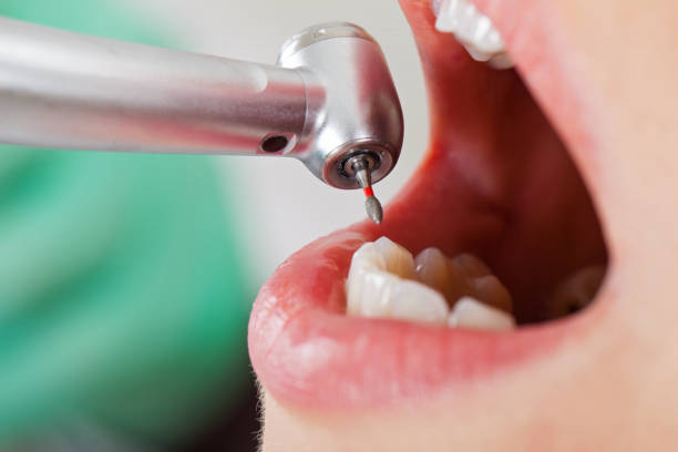 Best Lost Filling or Crown Replacement in Edisto, SC